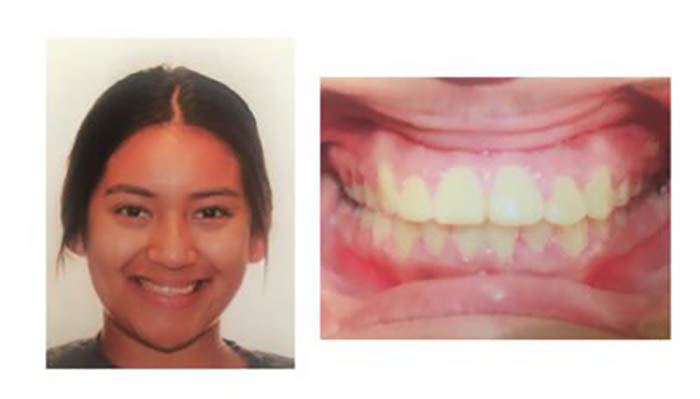 Pasadena Orthodontics Patient Amalia C after