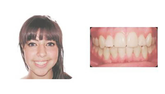 Pasadena Orthodontics Patient Daisy O after