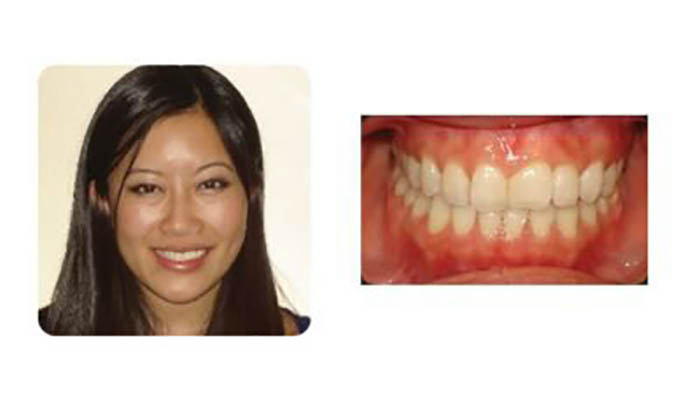 Pasadena Orthodontics Patient Elizabeth Y after