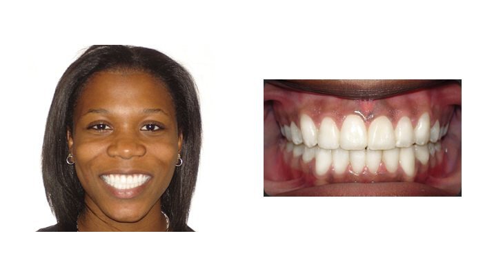 Pasadena Orthodontics Patient Young Lady 2 after