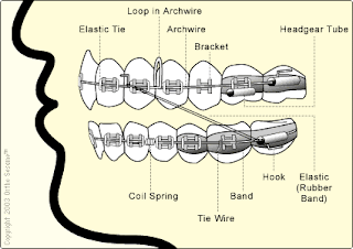 Braces Diagram