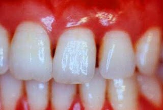Closeup of gums