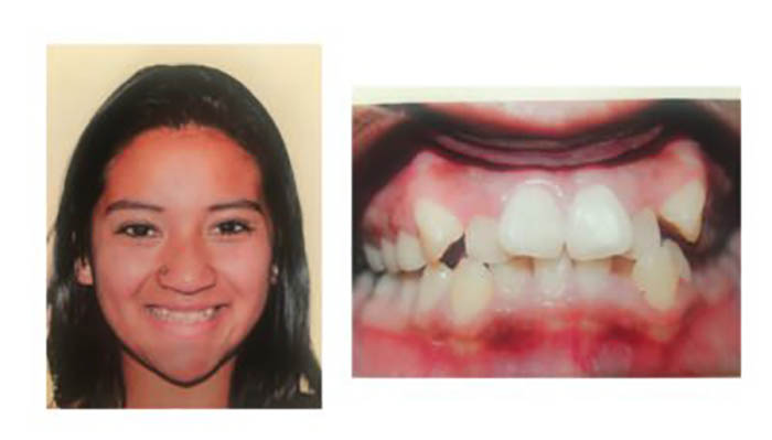 Orthodontics Orthodontics Patient Amalia C before