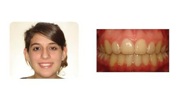 Orthodontics Orthodontics Patient Ashley R after