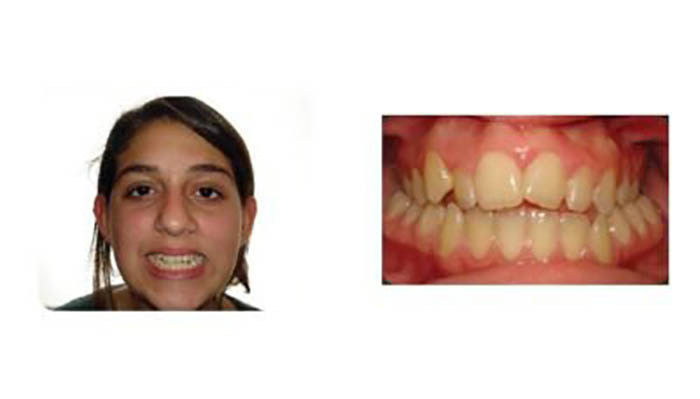 Pasadena Orthodontics Patient Ashley R before