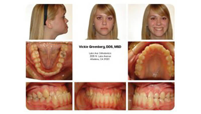 Orthodontics Orthodontics Patient Brodie R before