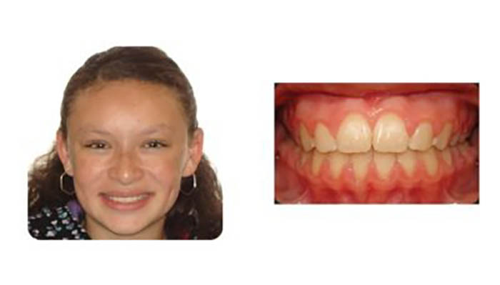Orthodontics Orthodontics Patient Colleen T after