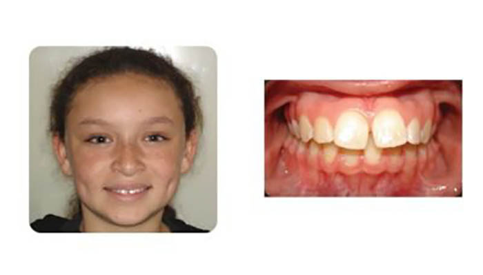 Orthodontics Orthodontics Patient Colleen T before