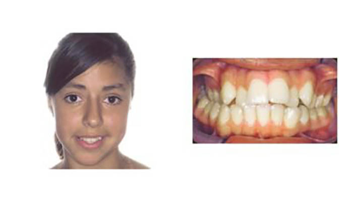 Orthodontics Orthodontics Patient Daisy O before