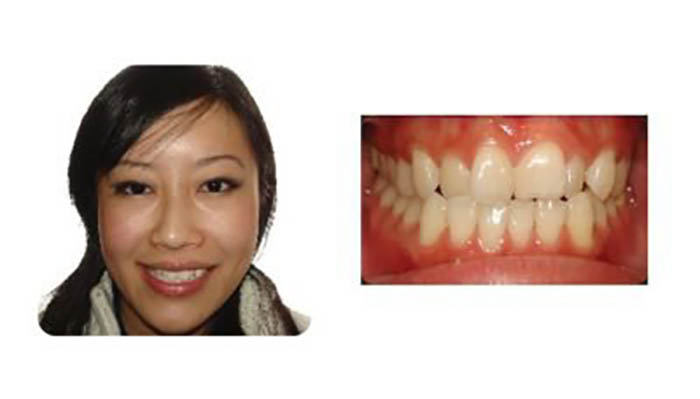 Orthodontics Orthodontics Patient Elizabeth Y before