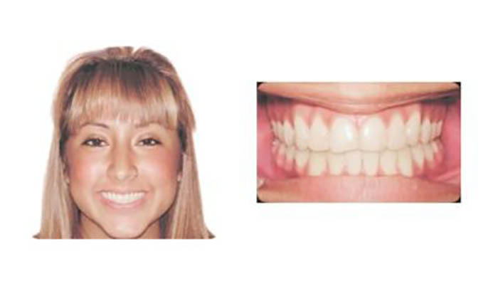 Orthodontics Orthodontics Patient Jenny C after