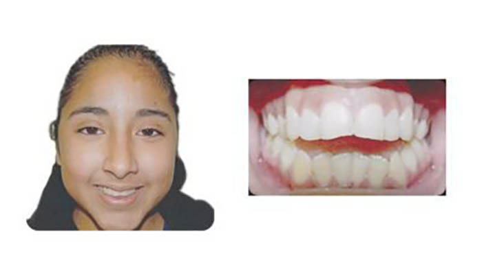 Orthodontics Orthodontics Patient Jenny C before