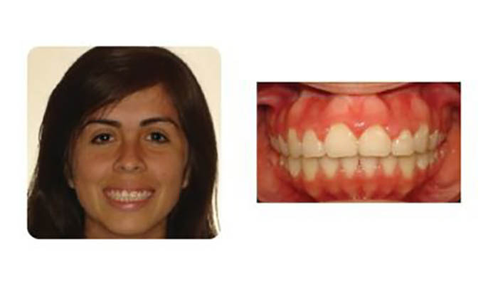 Pasadena Orthodontics Patient Pricilla H after