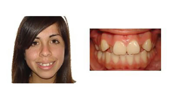 Orthodontics Orthodontics Patient Pricilla H before