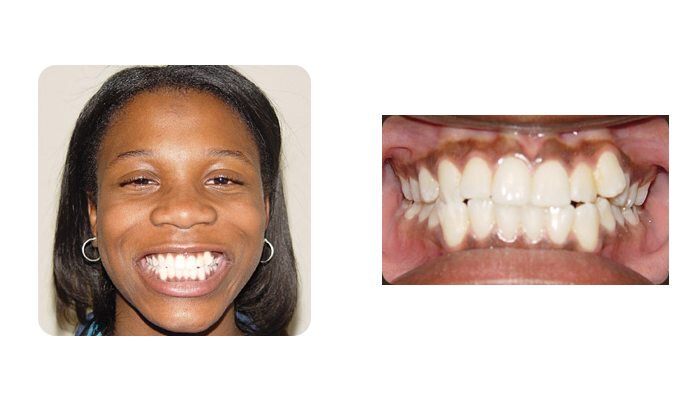 Orthodontics Orthodontics Patient Young Lady 1 before