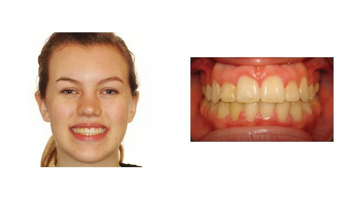 Orthodontics Orthodontics Patient Young Lady 2 after