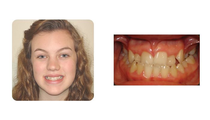 Orthodontics Orthodontics Patient Young Lady 2 before