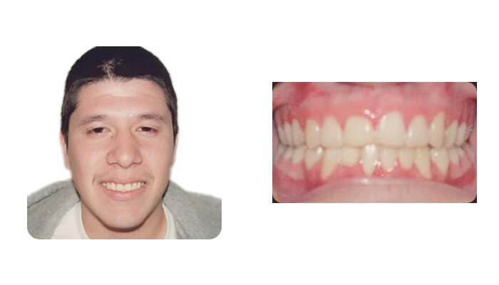 Orthodontics Orthodontics Patient Young Man 1 after