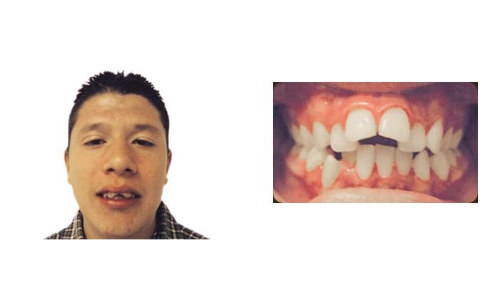 Pasadena Orthodontics Patient Young Man 1 before